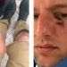 Lesionan policías a ciudadano al confundirlo con un delincuente