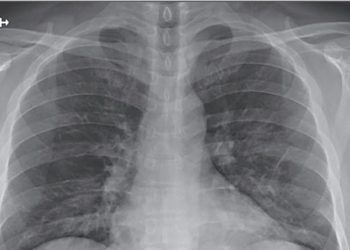 COVID-19 podría dejar un deterioro en la función pulmonar: experto