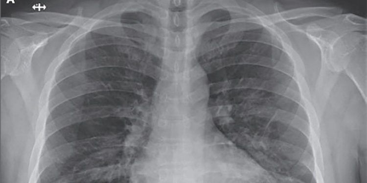 COVID-19 podría dejar un deterioro en la función pulmonar: experto