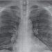 COVID-19 podría dejar un deterioro en la función pulmonar: experto