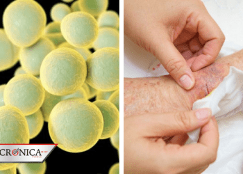 Hongo candida auris alarma por aparecer en pacientes con COVID-19