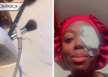 Joven revela que cargador de celular dañó su ojo y muestra recuperación en video