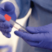 Células madre, avance para combatir el lupus