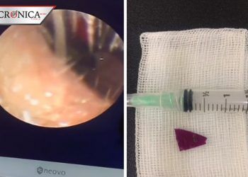 Doctora muestra en TikTok que encontró vidrio y madera en oído de niño