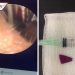 Doctora muestra en TikTok que encontró vidrio y madera en oído de niño