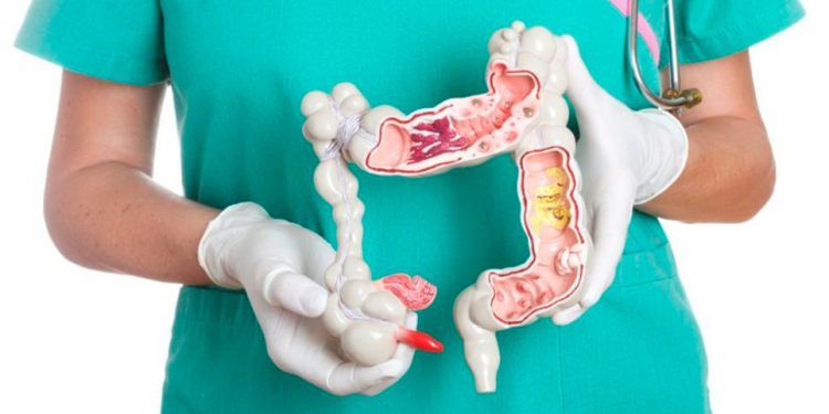 Casos de cáncer colorrectal pueden aumentar 72 % en México en 2040