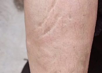 SSP ofrece apoyo a mujer atacada con ácido en Angelópolis 