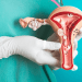 Mujeres mexicanas de 15 a 59 años en riesgo de padecer cáncer de ovario