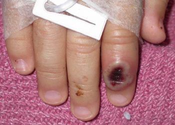 Actual viruela del mono tiene síntomas diferentes a brotes anteriores