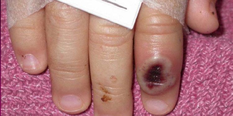 Actual viruela del mono tiene síntomas diferentes a brotes anteriores