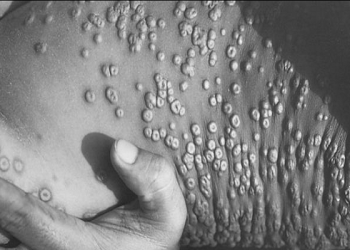 Registra Estados Unidos 2 mil 981 casos de viruela del mono