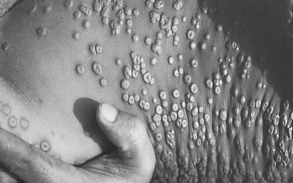 Registra Estados Unidos 2 mil 981 casos de viruela del mono