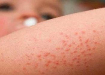 Dermatitis atópica, mal diagnosticada