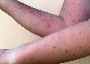 Van 12 casos de viruela símica en Puebla; hay cuatro activos