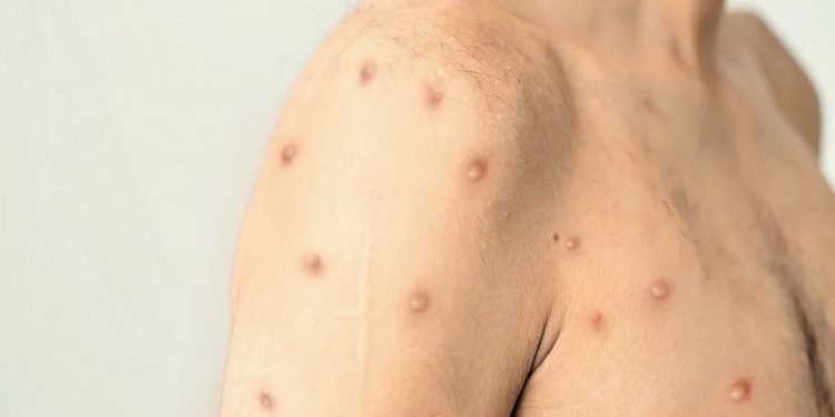 Cinco casos más de viruela símica en una semana