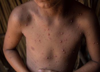 Ninguna muerte en 33 pacientes de viruela símica