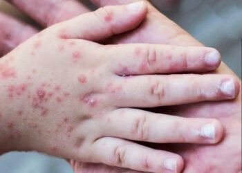 OMS mantiene nivel de alerta máxima para la viruela del mono