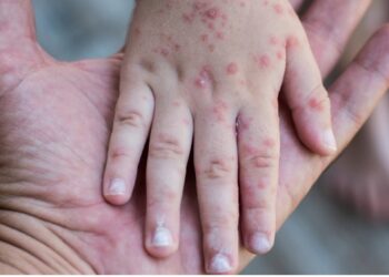 Reportan siete casos de virus coxsackie