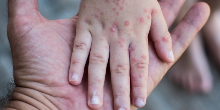 Reportan siete casos de virus coxsackie