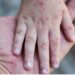 Reportan siete casos de virus coxsackie