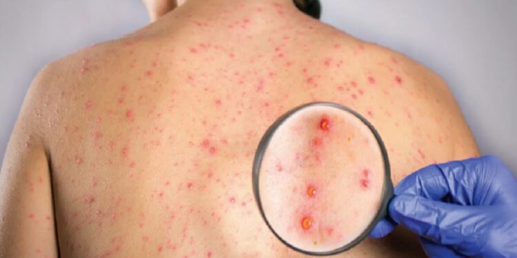Nueve de cada 10 personas no vacunadas, en riesgo de contagio